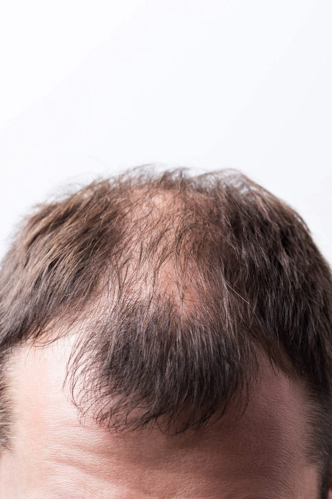 FUE Hair Transplant Seattle Hair Restoration Seattle