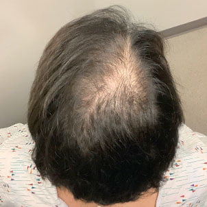 Hair Transplant Case 04