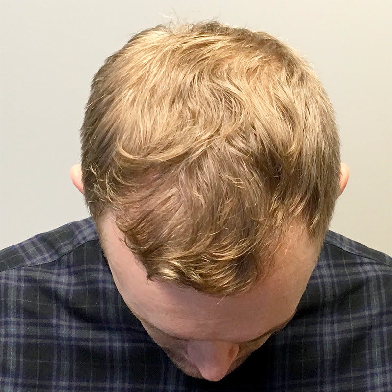 Hair Transplant Case 02