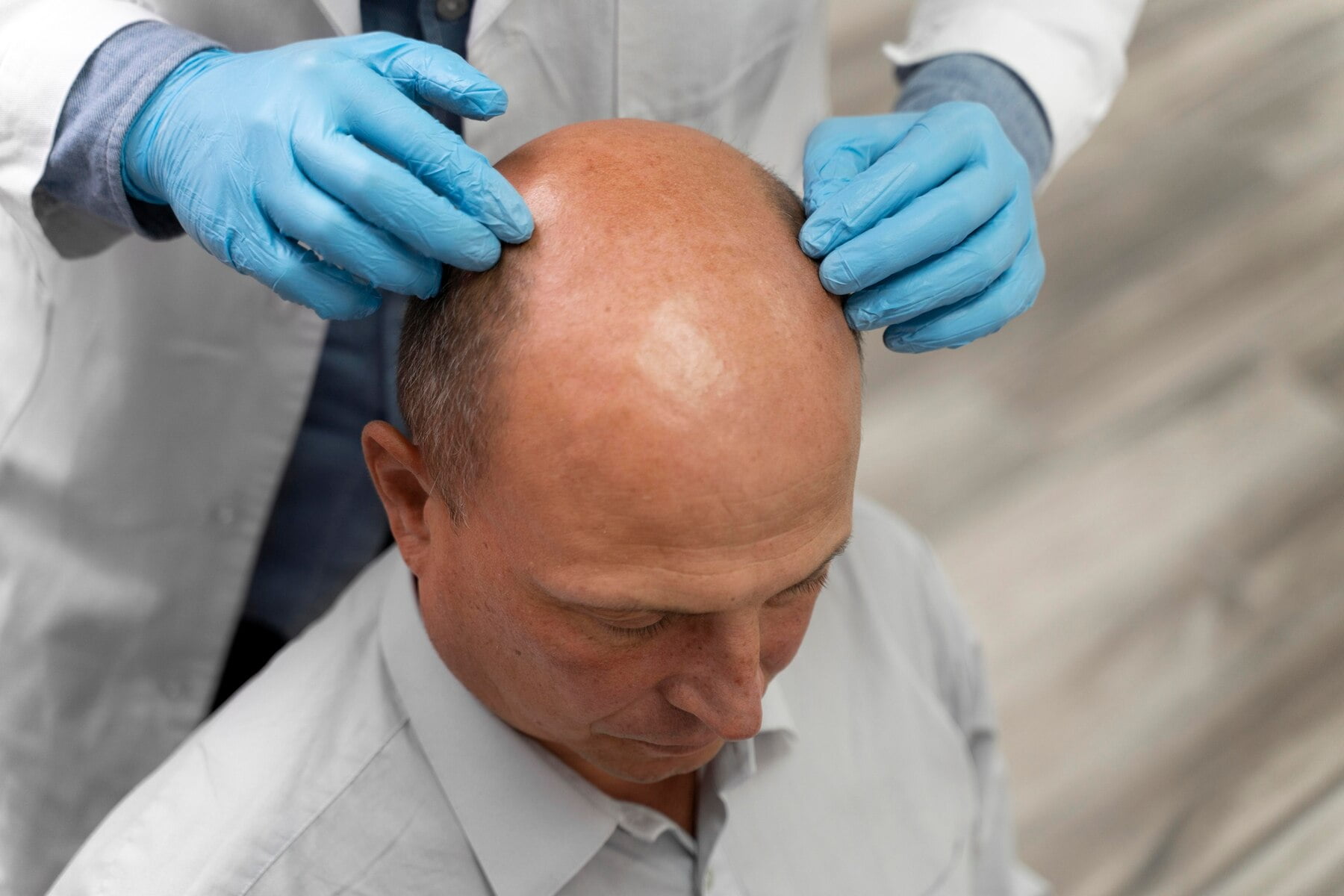 Why Age Matters in Hair Transplant Success