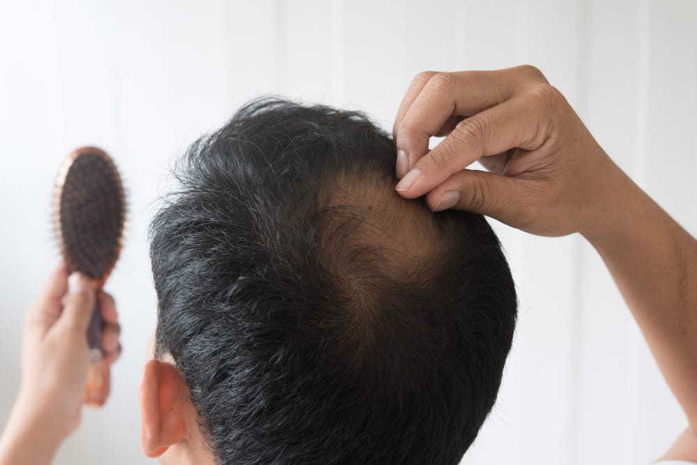 Hair Transplant