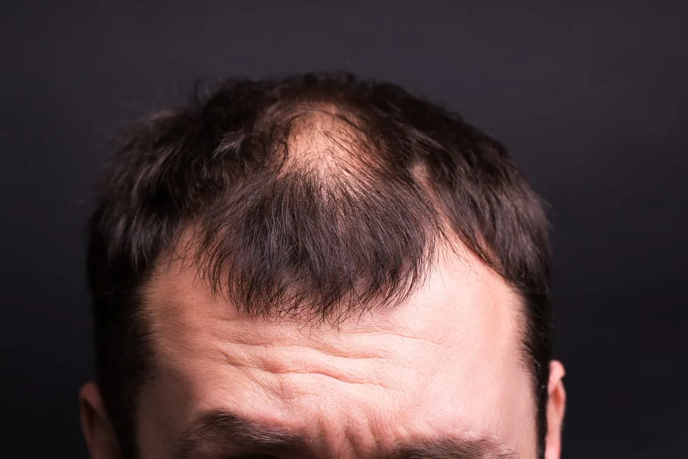 can transplanted hair fall out