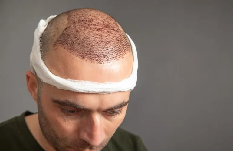 Hair transplant after hair transplant
