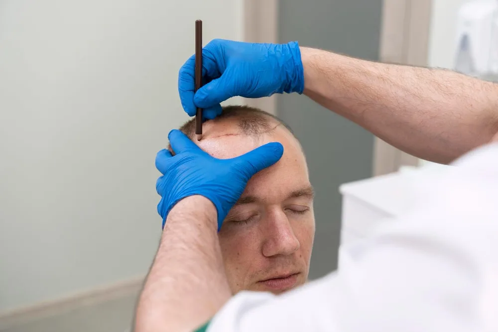 Week 3 after hair transplant
