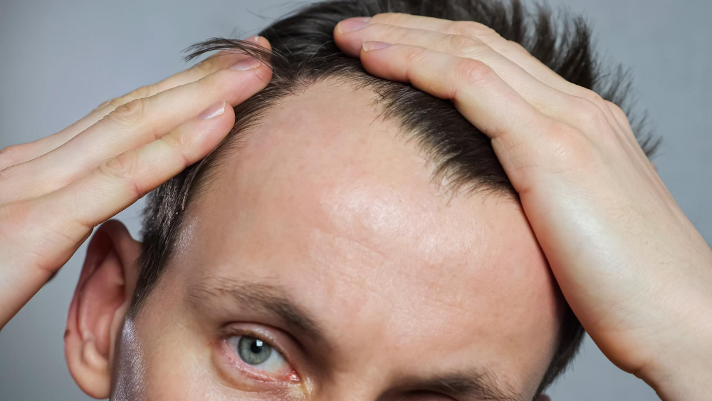 Forehead Reduction Performed