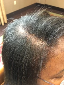 scarring alopecia