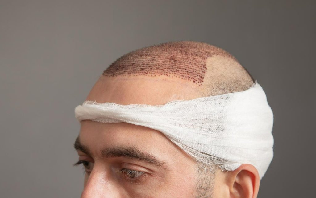 How to Remove Scabs After Hair Transplant