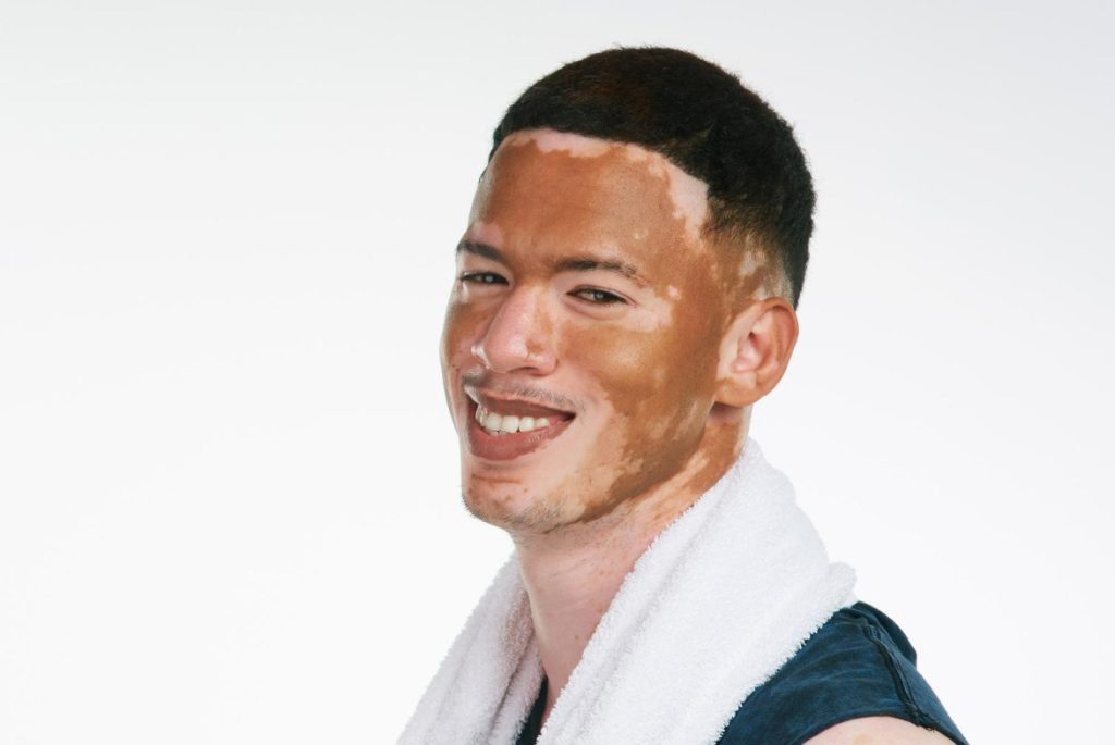 Does Vitiligo Affect Hair