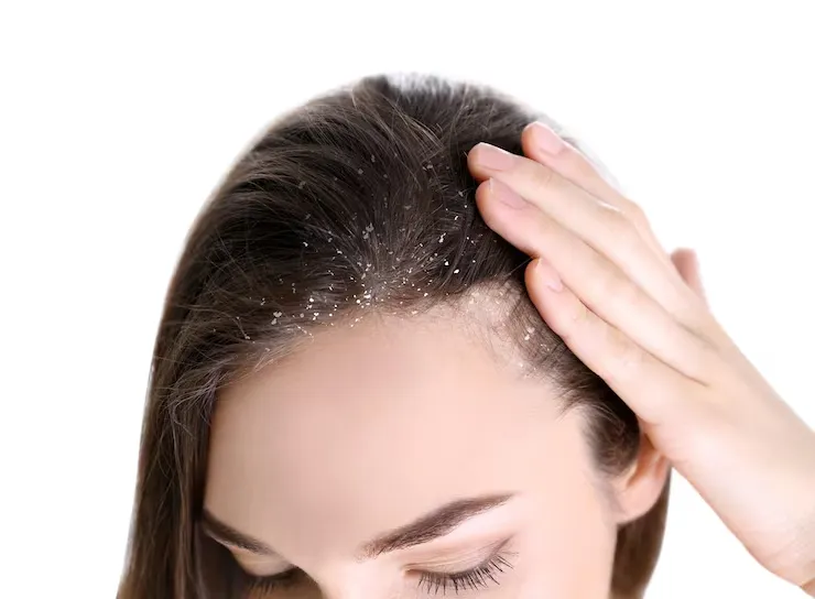 Can Dandruff Cause Hair Loss? What’s True and What’s Not